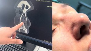 Почему не дышит нос? Рассказываю о изменениях на КТ.