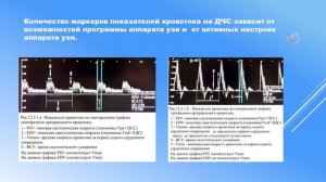 Выпуск 22, часть 5. Метки показателей на ДЧС. Количественные показатели кровотока на ДЧС.