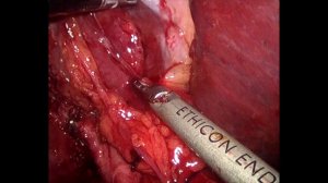 Laparoscopic ALPPS Right trissegmentectomy