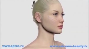 Нитевой лифтинг Aptos