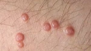 Herpes Simplex Virus - causes, symptoms and treatment