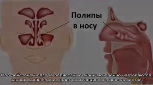 Удаление полипов в носу лазером