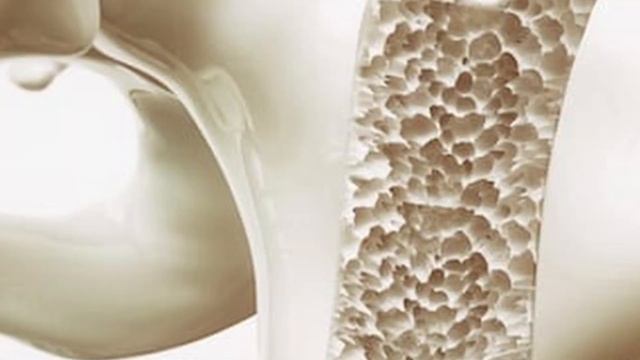 Can This Constipation Treatment be a Dementia Cure?