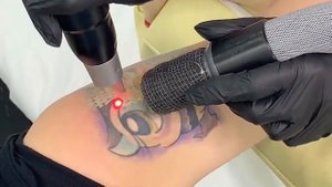 ЛАЗЕРНОЕ УДАЛЕНИЕ ТАТУИРОВКИ НА ПЛЕЧЕ. КЛИНИКА "ET.LASER" Москва.