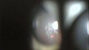 Барраж локальных отслоек сетчатки