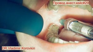 Проводниковая анестезия для лечения 46. Кейс#29.
