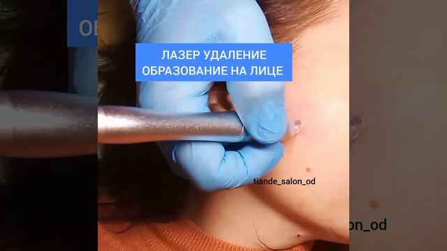 Лазерное удаление образований на теле
