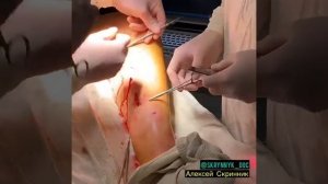 Лазерное лечение вен. Микрофлебэктомия. Флеболог Алексей Скринник. Киев