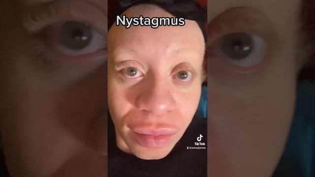 Nystagmus & Albinism #albino #albinism #albinismo #nystagmus #blindness #blindnessawareness #eyes