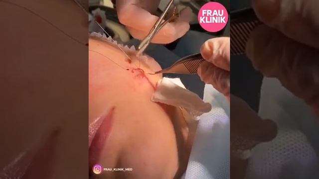 Удаление атеромы на лице.