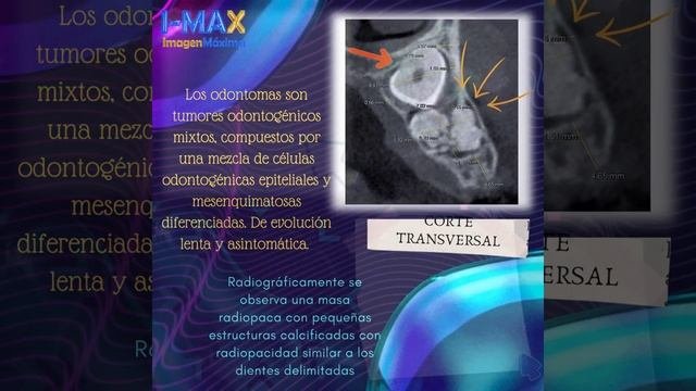 ODONTOMA