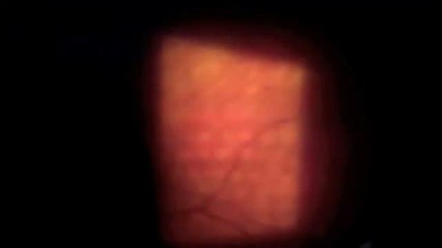 Парнретинальная лазеркоагуляция при сахарном диабете Panretinal Laser Coagulation, Topcon, Pascal