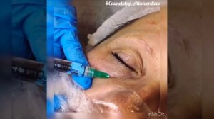 Вы хотите самое красивое лицо?🥰Cytocare VIP препарат❤️💣