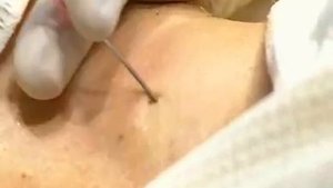 Пункция и катетеризация внутренней яремной вены