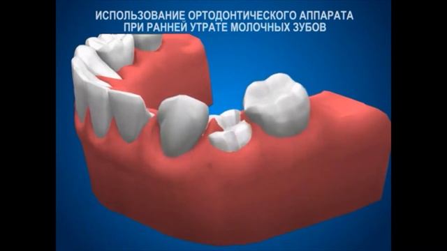 ортодонтия аппараты