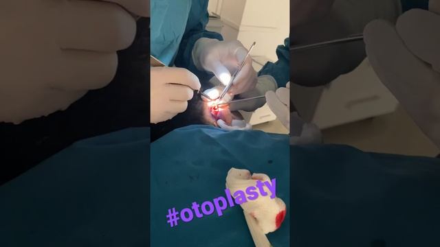 Процесс проведения операции Отопластика (пластика ушной раковины). #otoplasty #отопластика