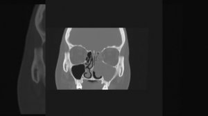 Maxillary sinonasal polyp - coronal