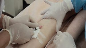 Компрессионная склеротерапия варикозных вен в Смоленске