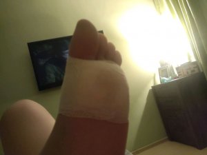 Мне пришекали лазером в бородавку