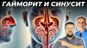 Гайморит и Синусит - Эти способы помогут избавиться навсегда