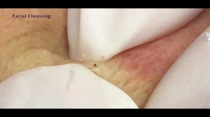 #13 Blackhead Removal \ Удаление черных точек