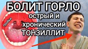 Как избавиться от гнойных пробок _ Тонзиллит. Упражнения, полоскание, рекомендации