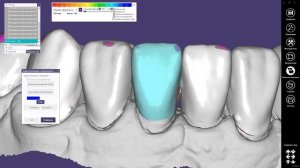 Виниры Exocad: 4) моделирование / Veneers Exocad: 4) modellation