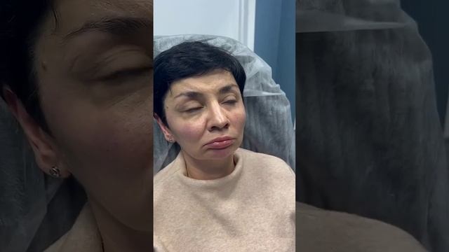 Как правильно добавить объём филлерами под глаза? Обучение косметологов.