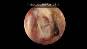 Холестеатома наружного слухового прохода