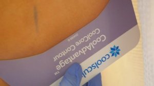 КРИОЛИПОЛИЗ ZELTIQ (ЗЕЛТИК)  CoolSculpting