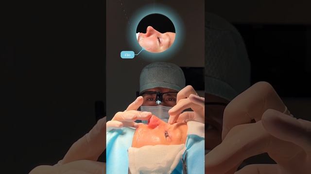 Результат риносептопластики на операционном столе 🤩🔥