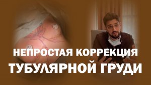 Коррекция тубулярной груди круглыми имплантами Ментор 325 мл