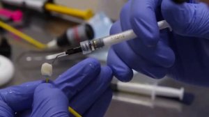 Фиксация керамической вкладки зуба 4.6.