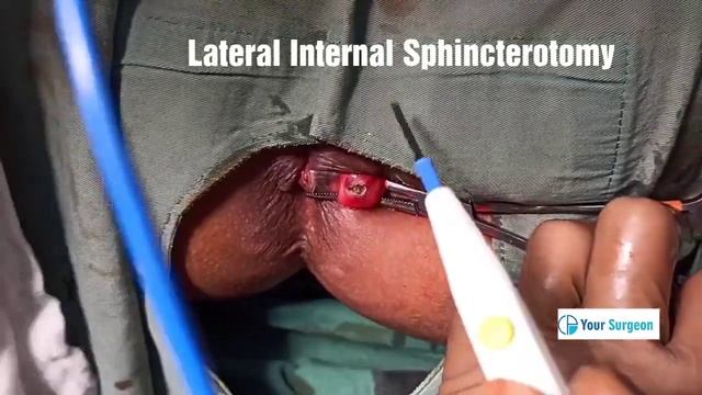 FISSURE & Sentinel skin Tag - TREATMENT смотреть онлайн