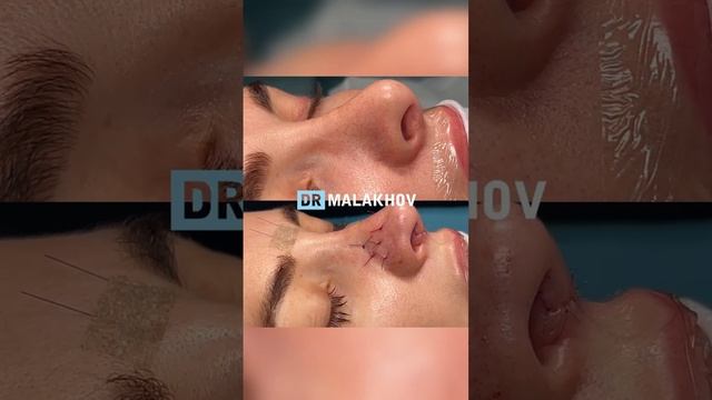 Крайне сложный случай вторичной риносептопластики 🫣