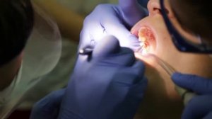 Фиксация штифтово-культевых вкладок