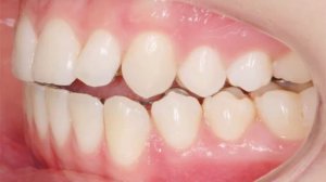 Исправление перекрестного прикуса брекетами