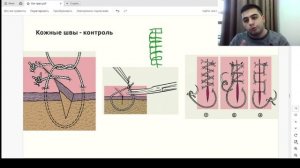 Урок - 11 «Шов Мультанского»