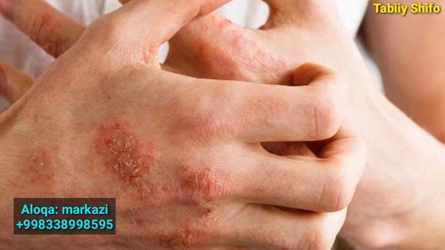 эшак еми касаллигини давоси тарвок касаллиг сабаблари ва Уни даволаш Tarmoqni uyda tabiiy davolash
