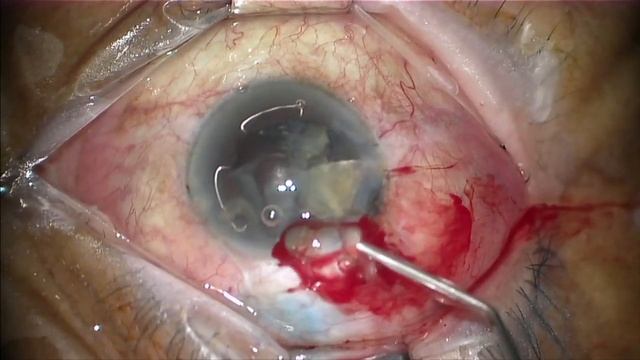 VII PHACODAY - Caso 01 Dr Ricardo Nose смотреть онлайн