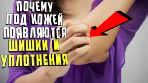 Почему под кожей появляются шишки и уплотнения