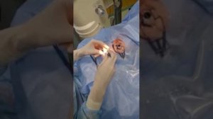 Операция по лечению катаракты, cataract surgery