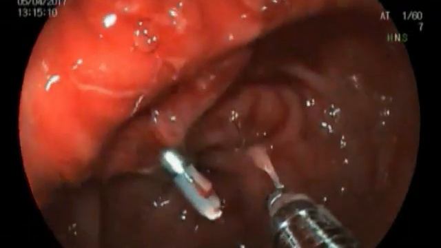 Diagnostic and treatment GI endoscopy смотреть онлайн