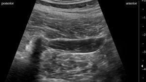 Quadratus lumborum (QL) block: Anterior approach