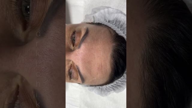 VISCODERM HYDROBOOSTER 💉 До/После✅ Без ботокса ⛔️