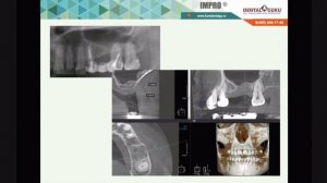 Хабиев К.Н. Предсказуемая имплантация в сложных клинических ситуациях