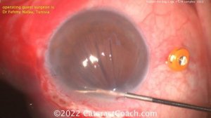 CataractCoach 1511: explant the bag + IOL + CTR complex