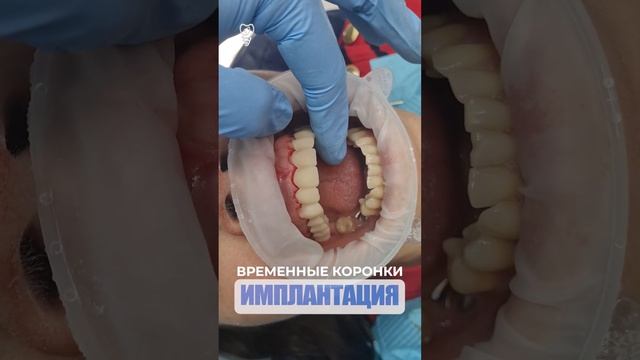 Новая моделировка зубов. New teeth modeling. Implantation.