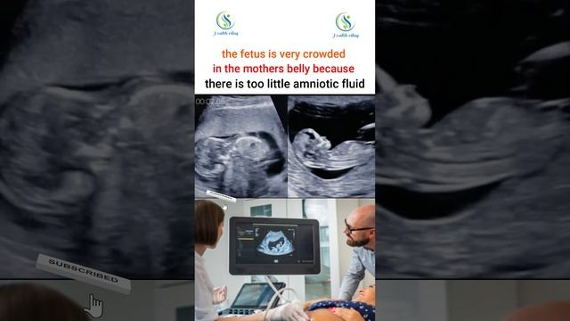 the fetus is very crowded in the mothers belly because there is too little amniotic fluid #fetus