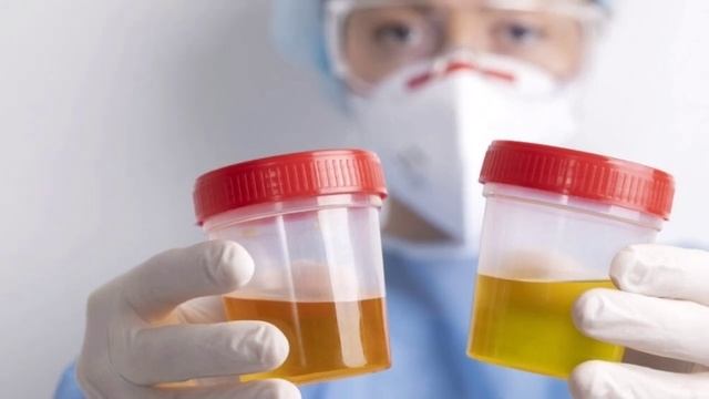 Bilirubin test in urine| Bile pigments | Bile salt | Urobilinogen| liver disease #urine